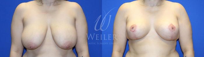 Before & After Breast Reduction Case 1214 Front View in Baton Rouge, New Orleans, & Lafayette, Louisiana
