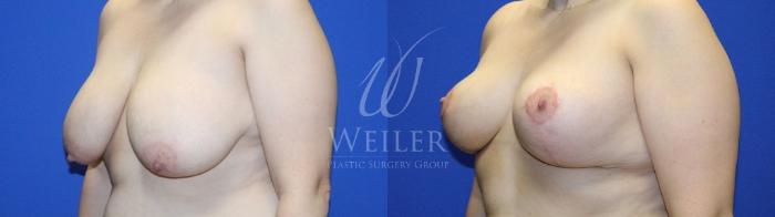 Before & After Breast Reduction Case 1214 Left Oblique View in Baton Rouge, New Orleans, & Lafayette, Louisiana