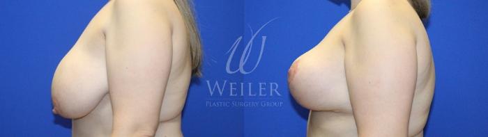 Before & After Breast Reduction Case 1214 Left Side View in Baton Rouge, New Orleans, & Lafayette, Louisiana