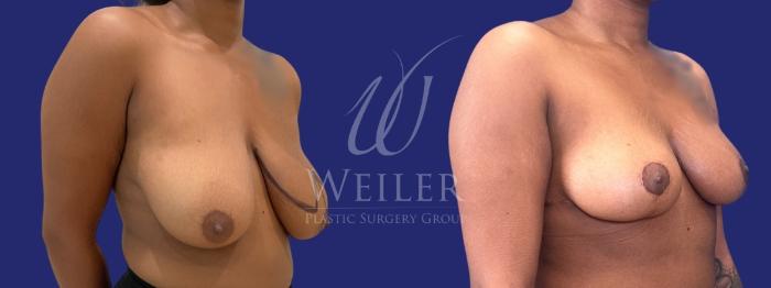 Before & After Breast Reduction Case 1258 Right Side View in Baton Rouge, New Orleans, & Lafayette, Louisiana