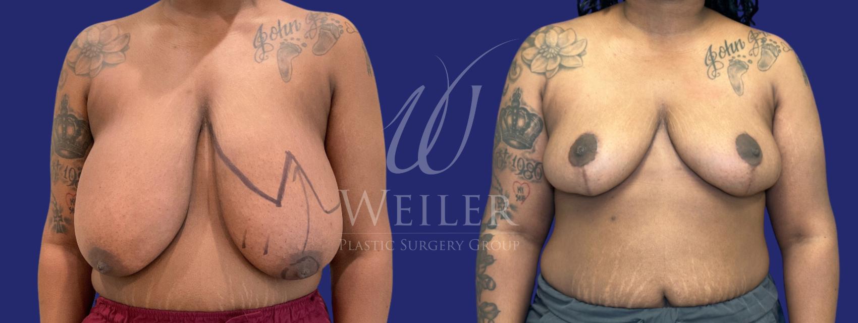 Before & After Breast Reduction Case 1327 Front View in Baton Rouge, New Orleans, & Lafayette, Louisiana