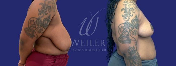 Before & After Breast Reduction Case 1327 Right Side View in Baton Rouge, New Orleans, & Lafayette, Louisiana