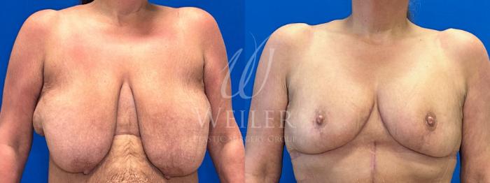 Before & After Breast Reduction Case 1336 Front View in Baton Rouge, New Orleans, & Lafayette, Louisiana