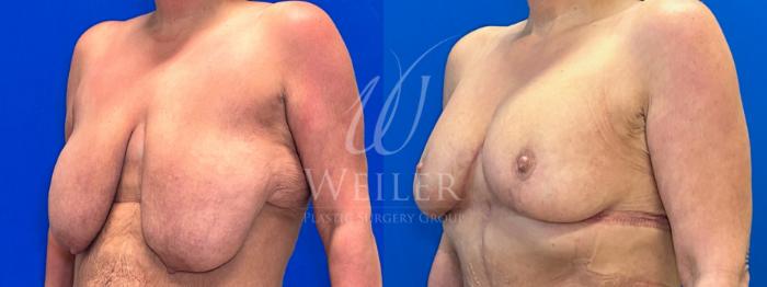 Before & After Breast Reduction Case 1336 Left Oblique View in Baton Rouge, New Orleans, & Lafayette, Louisiana