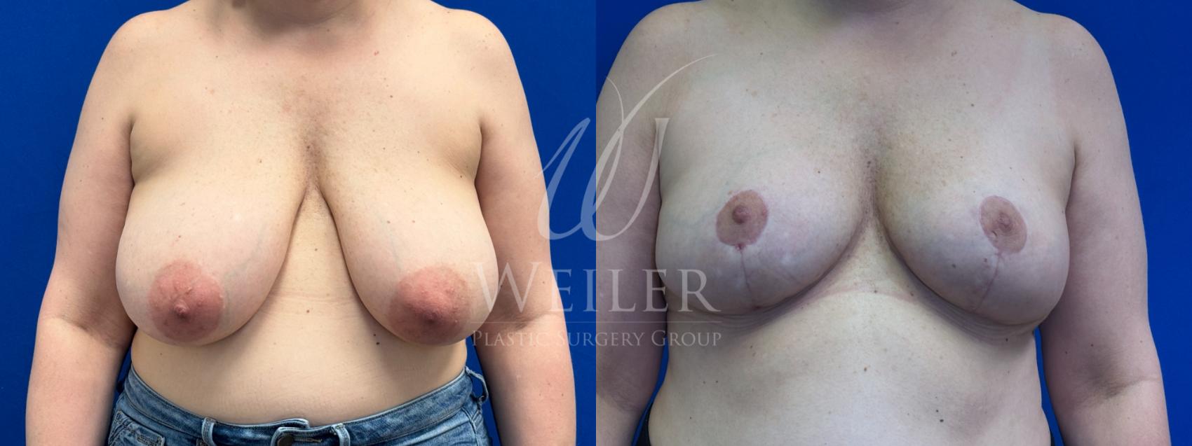 Before & After Breast Reduction Case 1347 Front View in Baton Rouge, New Orleans, & Lafayette, Louisiana