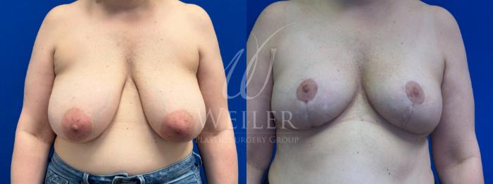 Before & After Breast Reduction Case 1347 Front View in Baton Rouge, New Orleans, & Lafayette, Louisiana