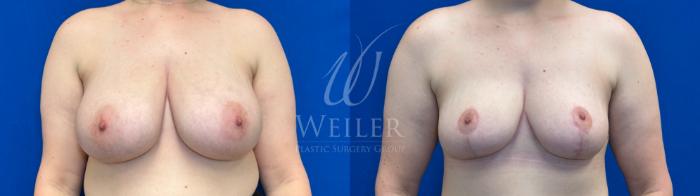 Before & After Breast Reduction Case 1388 Front View in Baton Rouge, New Orleans, & Lafayette, Louisiana