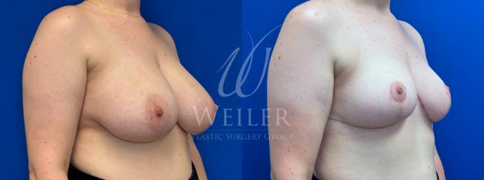 Before & After Breast Reduction Case 1388 Right Oblique View in Baton Rouge, New Orleans, & Lafayette, Louisiana