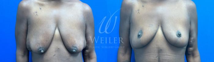 Before & After Breast Reduction Case 1413 Front View in Baton Rouge, New Orleans, & Lafayette, Louisiana