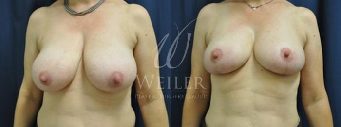 Before & After Breast Reduction Case 152 View #1 View in Baton Rouge, Louisiana