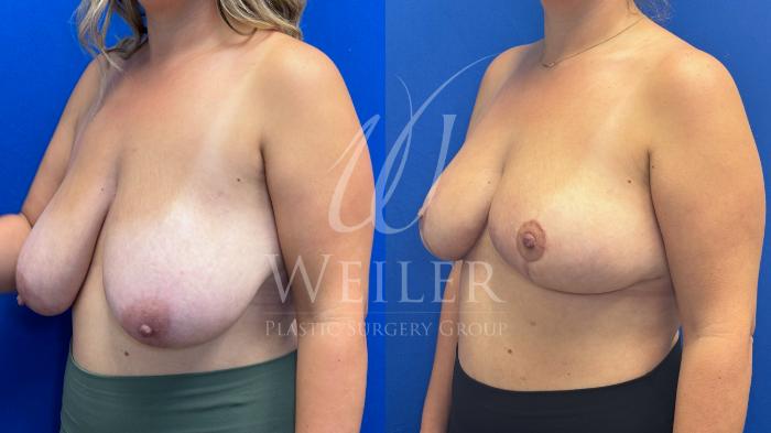Before & After Breast Reduction Case 1535 Left Side View in Baton Rouge, New Orleans, & Lafayette, Louisiana