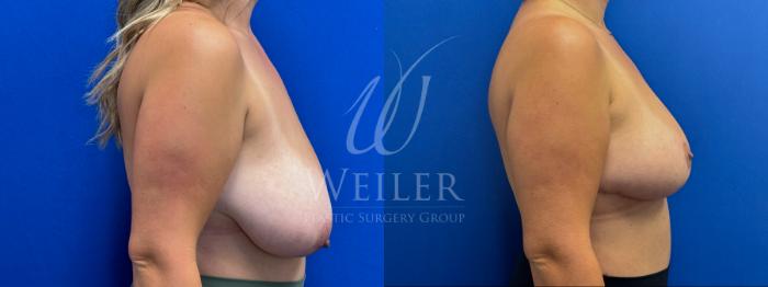Before & After Breast Reduction Case 1535 Right Side View in Baton Rouge, New Orleans, & Lafayette, Louisiana