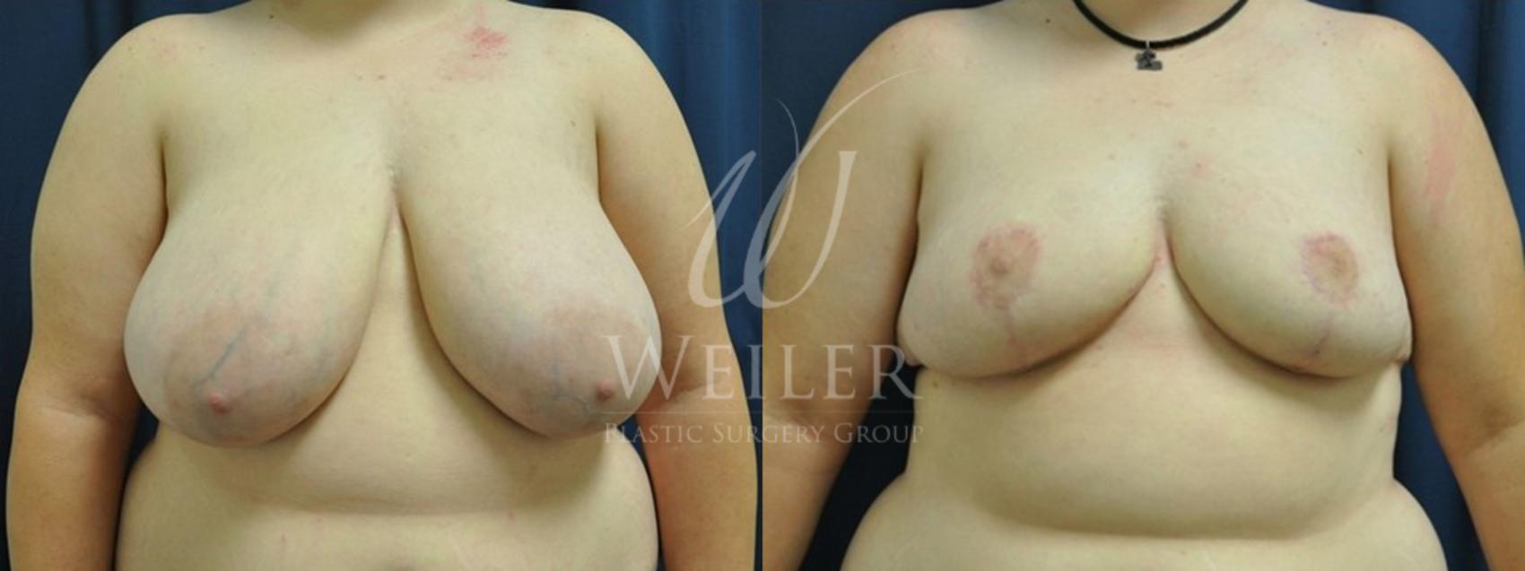 Before & After Breast Reduction Case 155 View #1 View in Baton Rouge, Louisiana