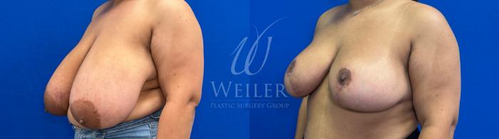 Before & After Breast Reduction Case 1553 Front View in Baton Rouge, New Orleans, & Lafayette, Louisiana