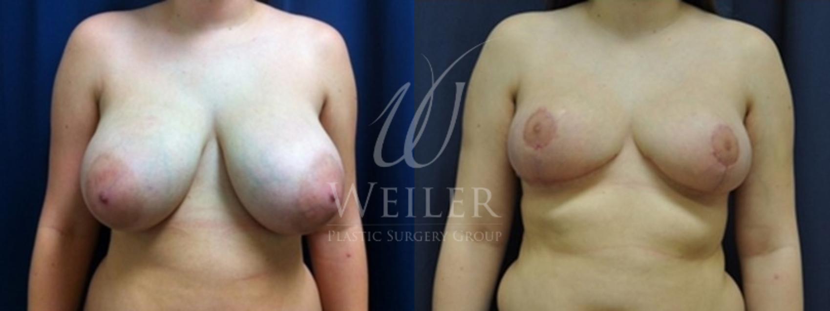 Before & After Breast Reduction Case 156 View #1 View in Baton Rouge, Louisiana