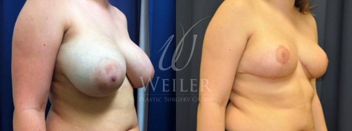Before & After Breast Reduction Case 156 View #2 View in Baton Rouge, New Orleans, & Lafayette, Louisiana