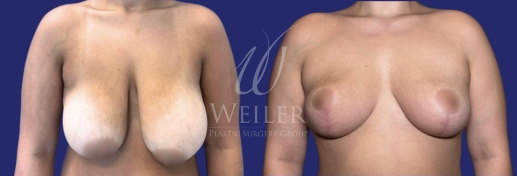 Before & After Breast Reduction Case 1604 Front View in Baton Rouge, New Orleans, & Lafayette, Louisiana