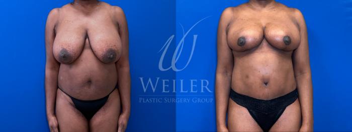 Before & After Tummy Tuck Case 1696 Front View in Baton Rouge, New Orleans, & Lafayette, Louisiana