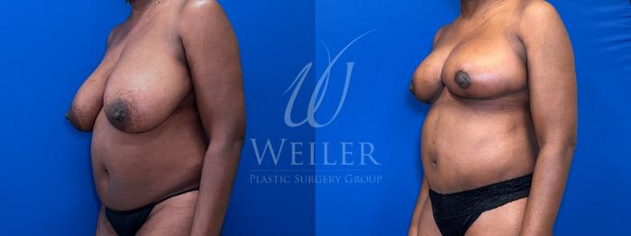 Before & After Tummy Tuck Case 1696 Left Oblique View in Baton Rouge, New Orleans, & Lafayette, Louisiana
