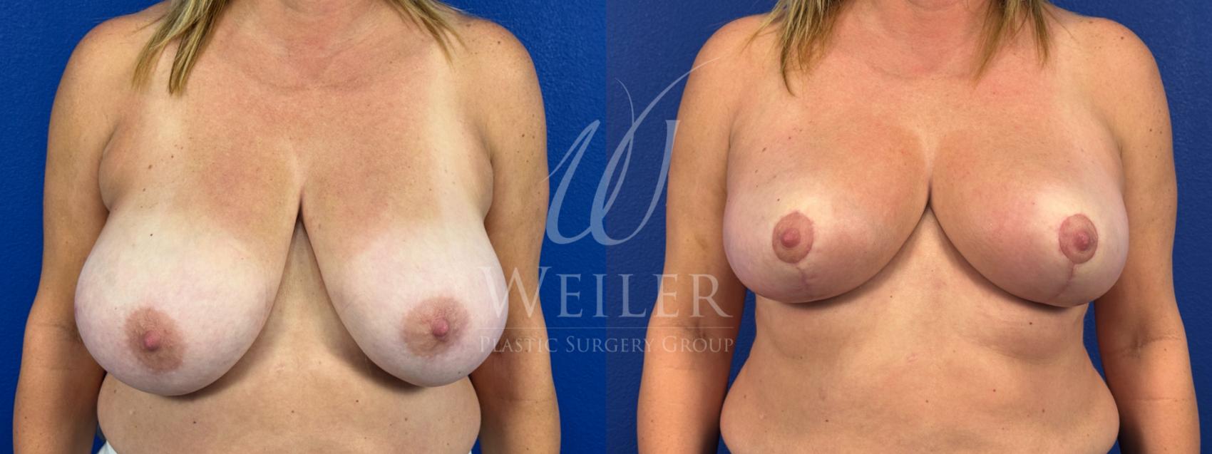 Before & After Breast Reduction Case 1718 Front View in Baton Rouge, New Orleans, & Lafayette, Louisiana