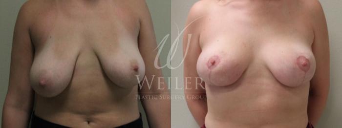 Before & After Breast Reduction Case 230 View #1 View in Baton Rouge, New Orleans, & Lafayette, Louisiana
