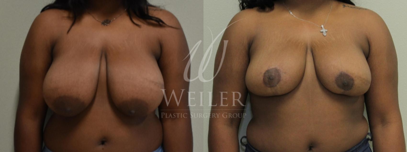 Before & After Breast Reduction Case 282 View #1 View in Baton Rouge, New Orleans, & Lafayette, Louisiana