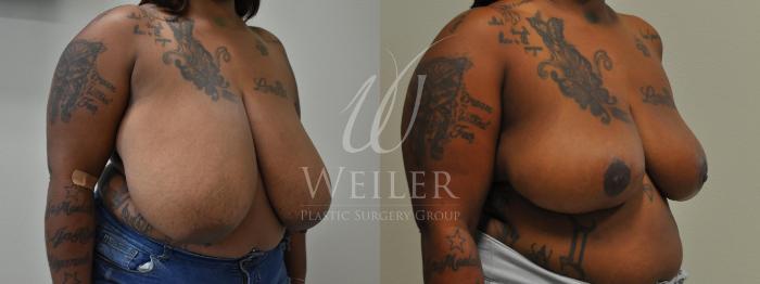 Before & After Breast Reduction Case 302 View #1 View in Baton Rouge, Louisiana