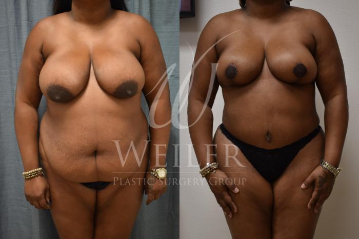 Before & After Breast Reduction Case 319 Front View in Baton Rouge, Louisiana