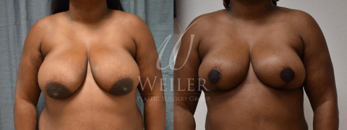 Before & After Breast Reduction Case 319 View #1 View in Baton Rouge, Louisiana