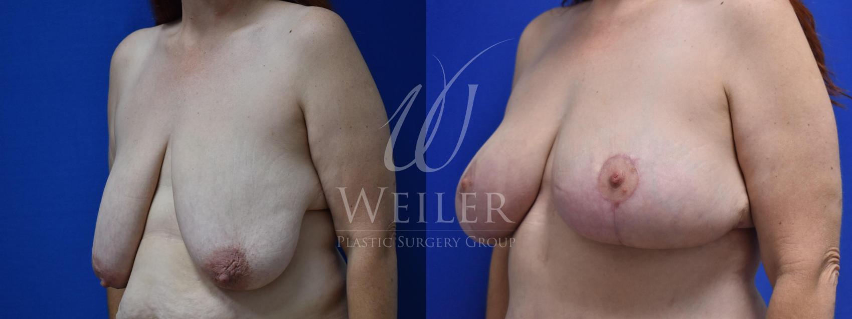 Before & After Breast Reduction Case 586 Left Oblique View in Baton Rouge, Louisiana