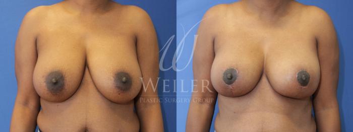 Before & After Breast Reduction Case 872 Front View in Baton Rouge, Louisiana