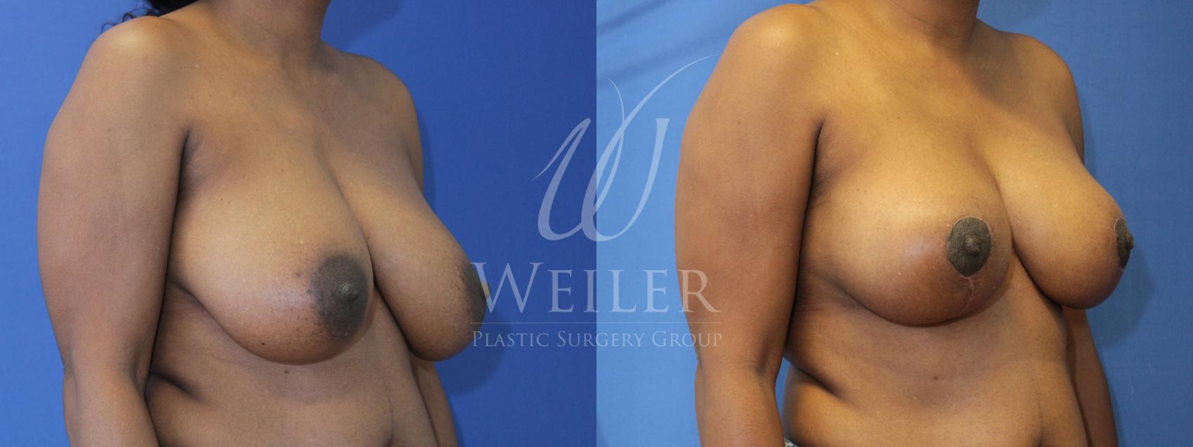 Before & After Breast Reduction Case 872 Right Oblique View in Baton Rouge, Louisiana