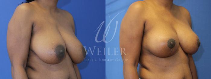 Before & After Breast Reduction Case 872 Right Oblique View in Baton Rouge, New Orleans, & Lafayette, Louisiana