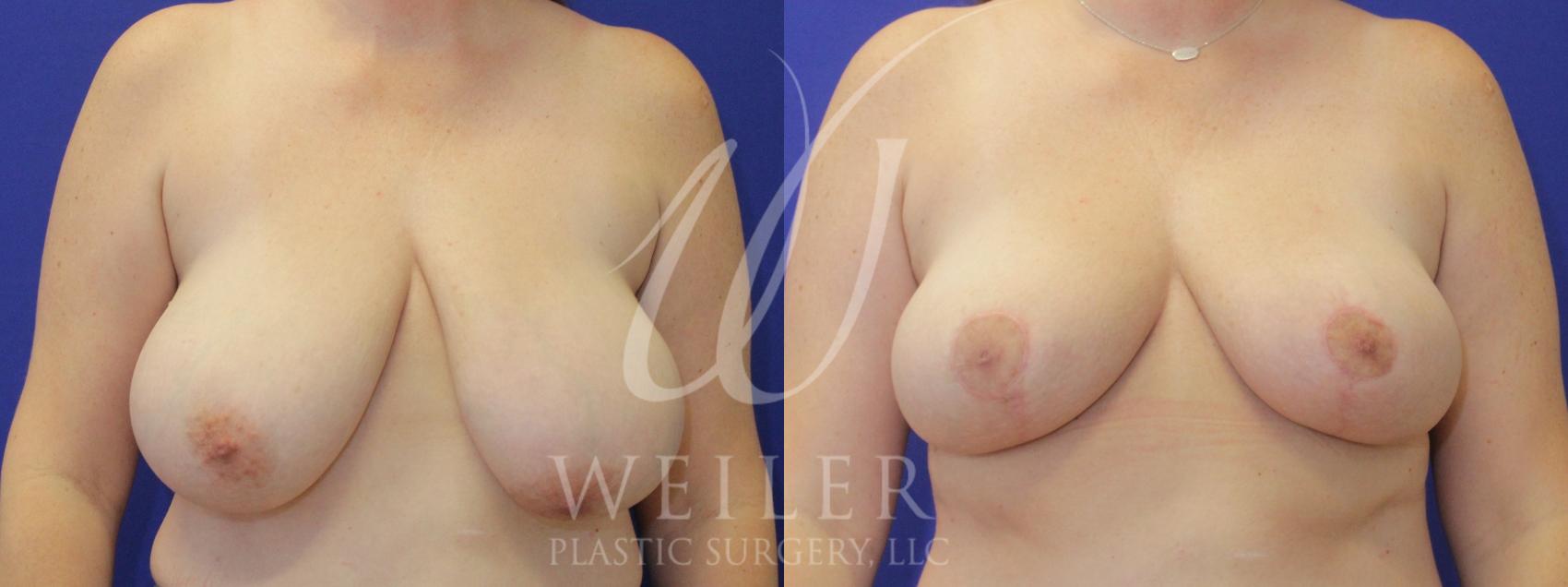 Before & After Breast Reduction Case 888 Front View in Baton Rouge, Louisiana