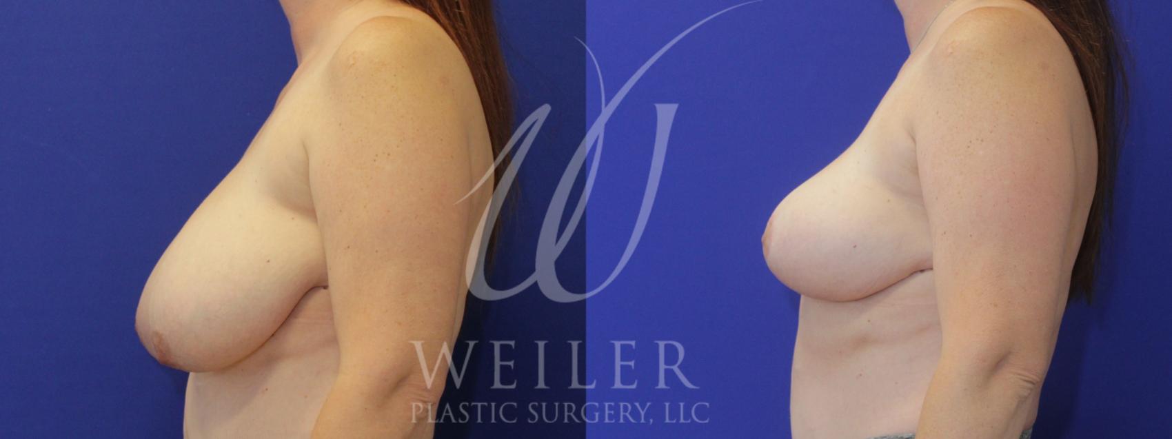 Before & After Breast Reduction Case 888 Left Side View in Baton Rouge, Louisiana