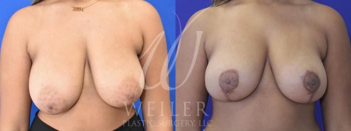 Before & After Breast Reduction Case 889 Front View in Baton Rouge, Louisiana