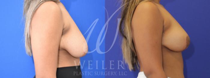 Before & After Breast Reduction Case 889 Right Side View in Baton Rouge, Louisiana