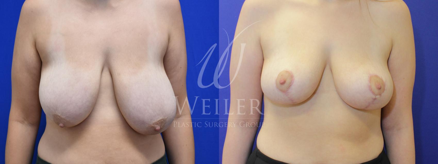 Before & After Breast Reduction Case 896 Front View in Baton Rouge, Louisiana