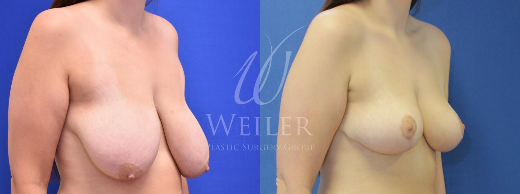 Before & After Breast Reduction Case 896 Right Oblique View in Baton Rouge, Louisiana