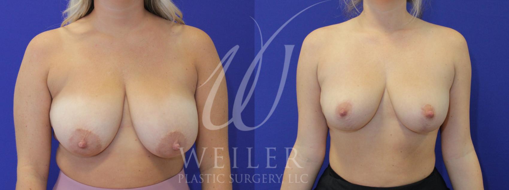 Before & After Breast Reduction Case 904 Front View in Baton Rouge, Louisiana