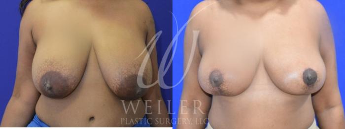 Before & After Breast Reduction Case 942 Front View in Baton Rouge, New Orleans, & Lafayette, Louisiana