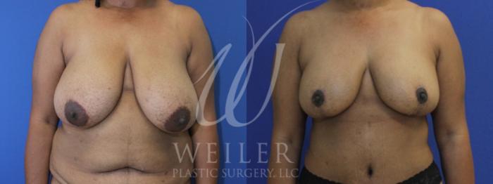 Before & After Breast Reduction Case 945 Front View in Baton Rouge, Louisiana
