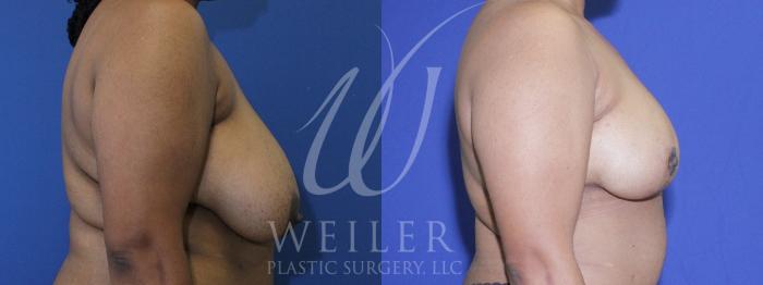 Before & After Breast Reduction Case 945 Right Side View in Baton Rouge, Louisiana