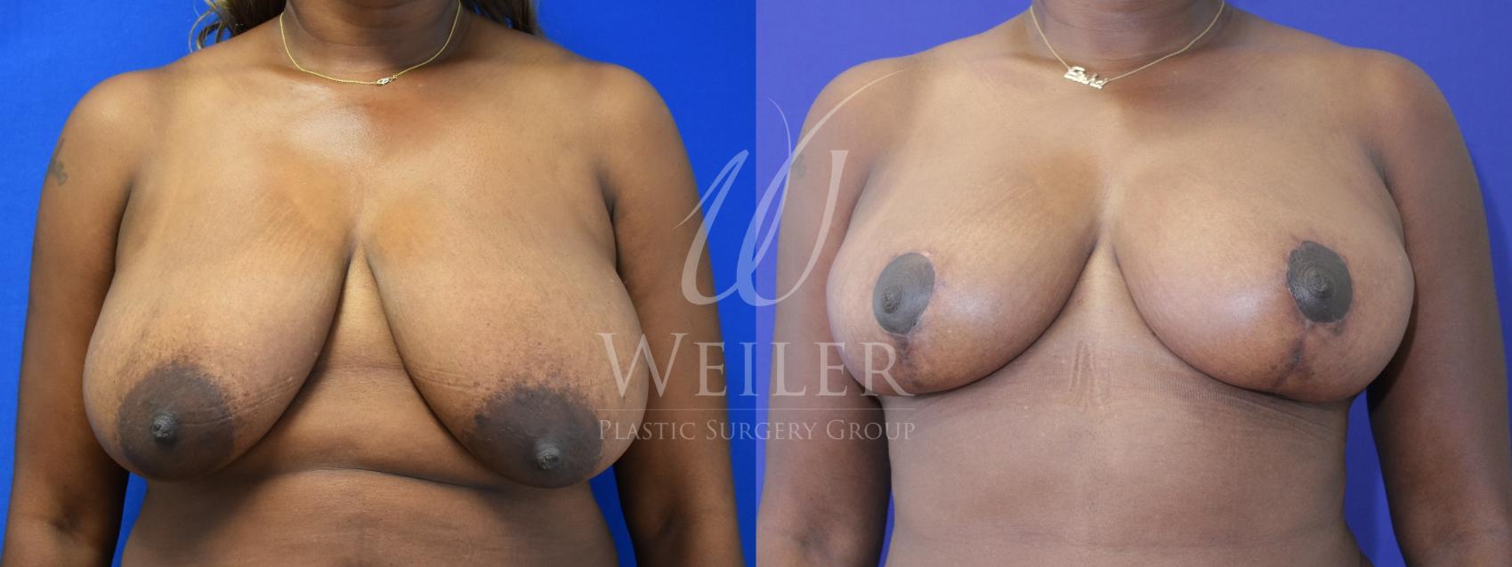 Before & After Breast Reduction Case 956 Front View in Baton Rouge, Louisiana