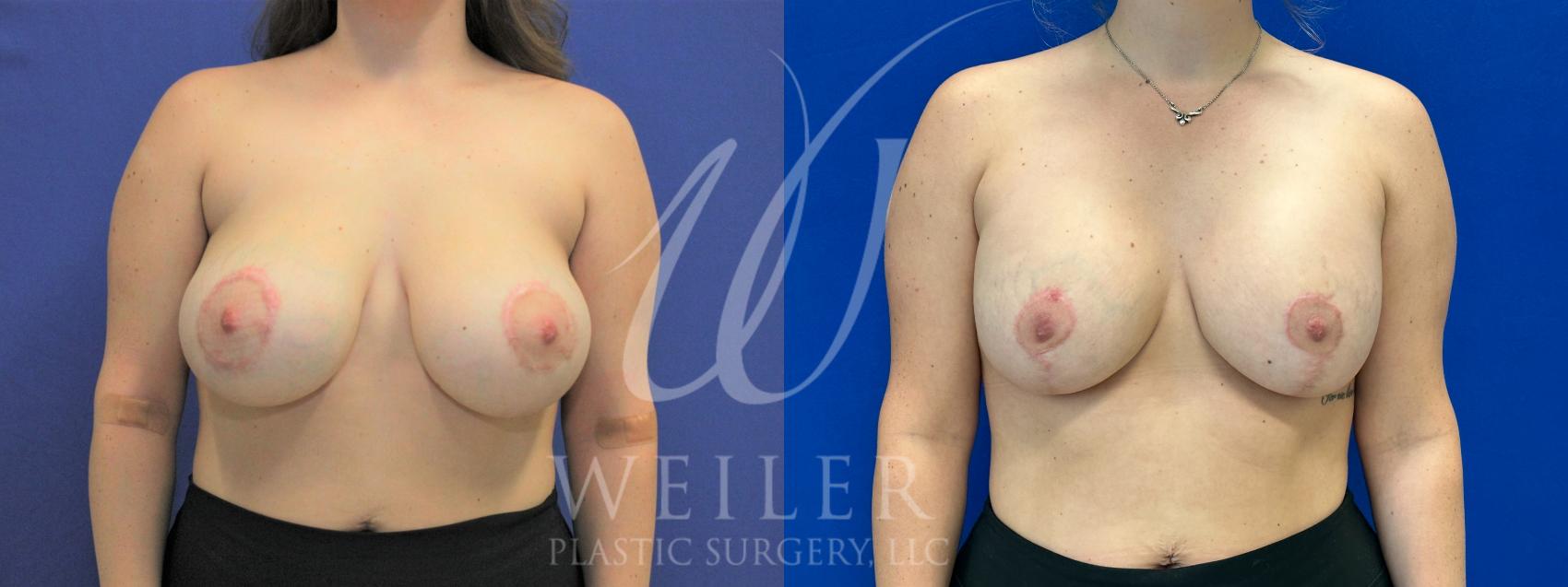 Before & After Breast Revision Case 1017 Front View in Baton Rouge, New Orleans, & Lafayette, Louisiana