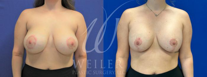 Before & After Breast Revision Case 1017 Front View in Baton Rouge, Louisiana