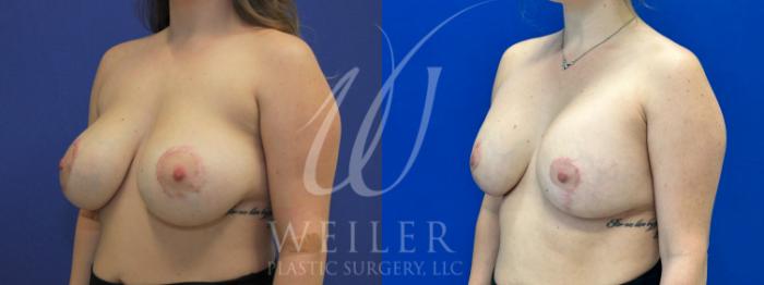 Before & After Breast Revision Case 1017 Left Oblique View in Baton Rouge, New Orleans, & Lafayette, Louisiana