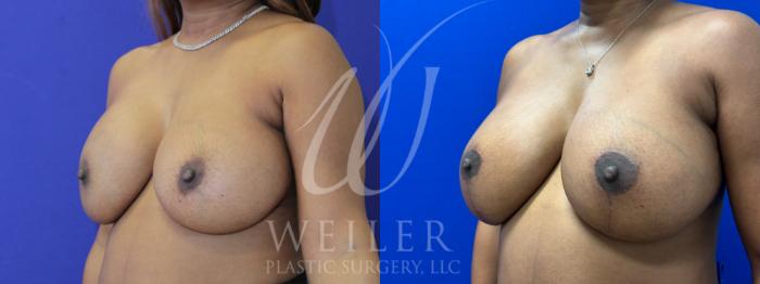 Before & After Breast Revision Case 1065 Left Oblique View in Baton Rouge, New Orleans, & Lafayette, Louisiana