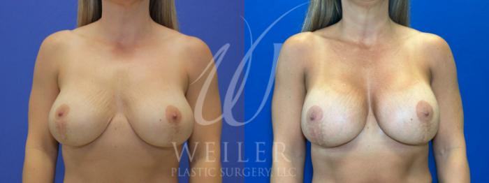 Before & After Breast Revision Case 1085 Front View in Baton Rouge, Louisiana