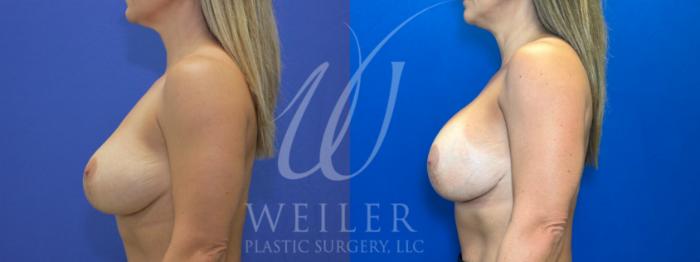 Before & After Breast Revision Case 1085 Right Side View in Baton Rouge, New Orleans, & Lafayette, Louisiana